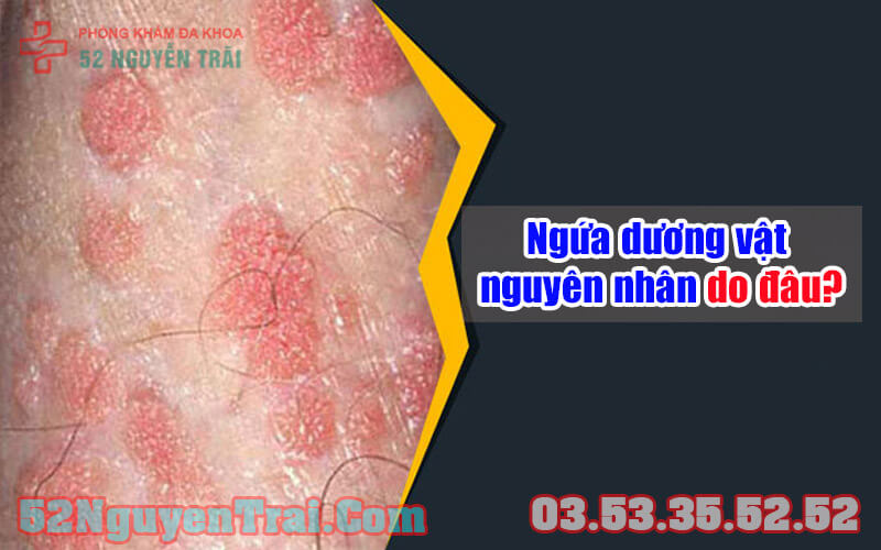 Ngứa dương vật nguyên nhân 1