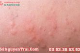 Hiv có ngứa không?