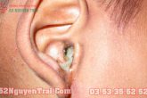 Chảy mủ ở tai – Cảnh báo bệnh ung thư không được xem nhẹ
