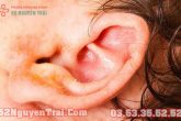 Nguyên nhân chảy mủ ở vành tai không phải ai cũng biết