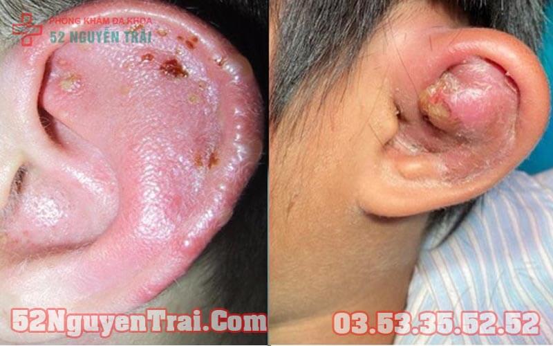 chay-mu-vanh-tai-3
