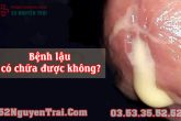 Bệnh lậu có chữa được không?