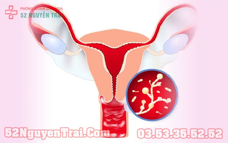 Chảy mủ vùng kín 1