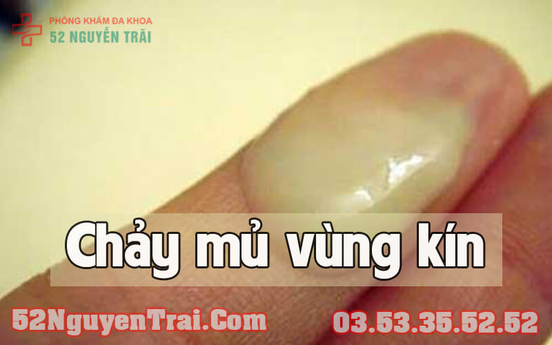 Chảy mủ vùng kín 6