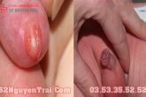 Hẹp bao quy đầu ở trẻ sơ sinh