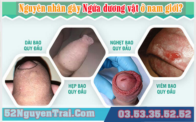 Ngứa dương vật kiêng ăn gì 1