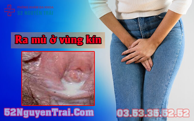 Ra mủ ở vùng kín