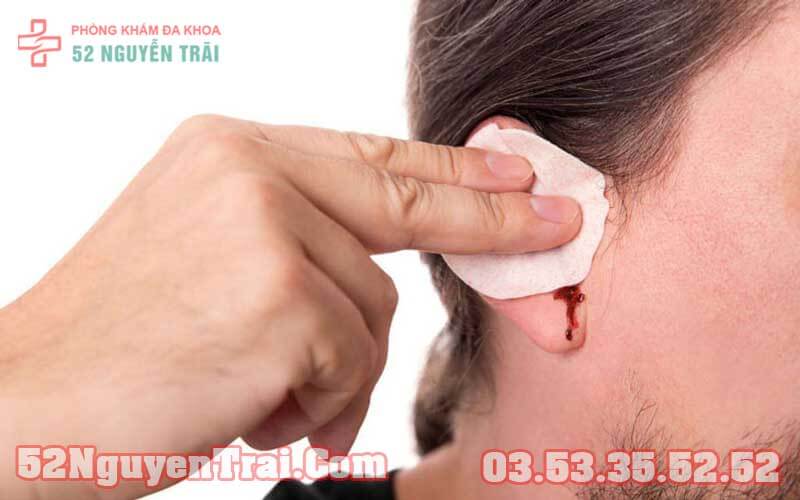 Tai chảy mủ trắng 1