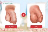 Thế nào là dài bao quy đầu?