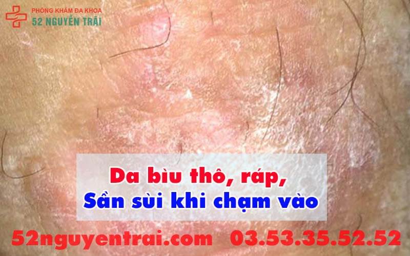 Bị ngứa bìu phải làm sao 2