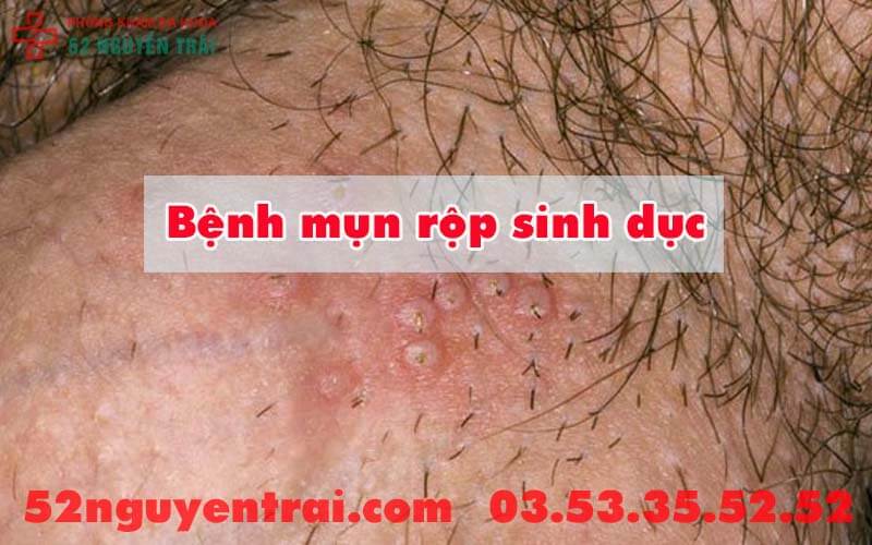 Bị ngứa bìu phải làm sao 3