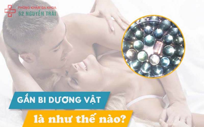 Gắn bi dương vật có tốt không