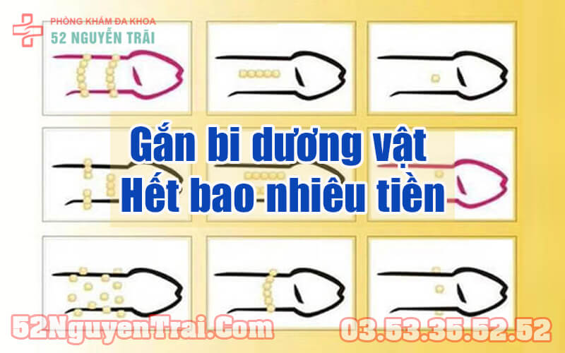 Gắn bi dương vật hết bao nhiêu tiền 2