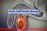 Giãn tĩnh mạch thừng tinh