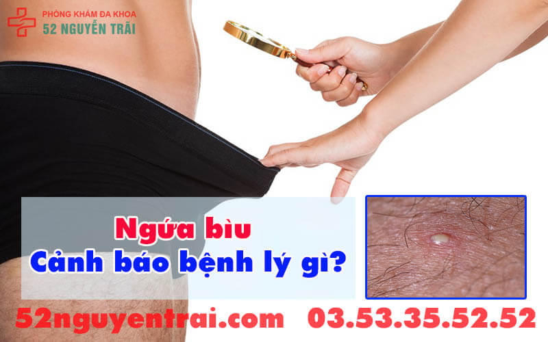 Ngứa bìu bôi thuốc gì