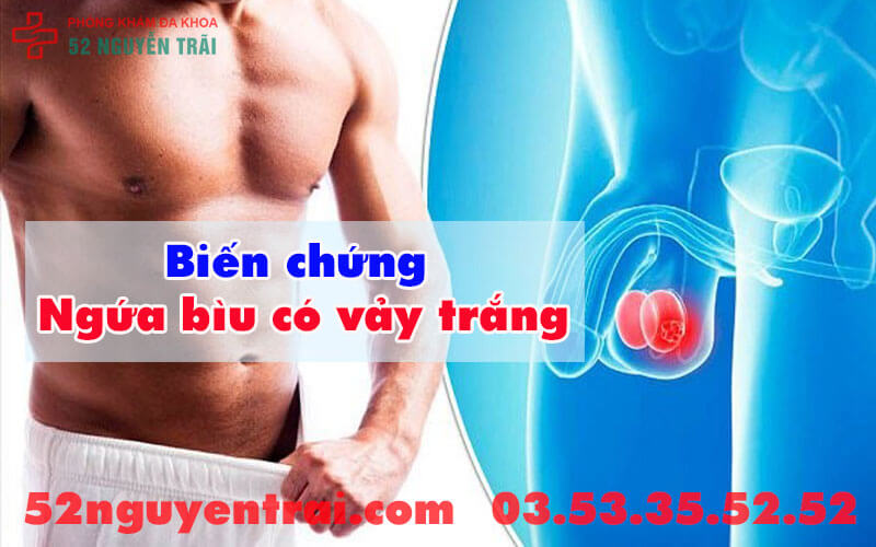 Ngứa bìu có vảy trắng 2