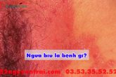 Ngứa bìu là bệnh gì?