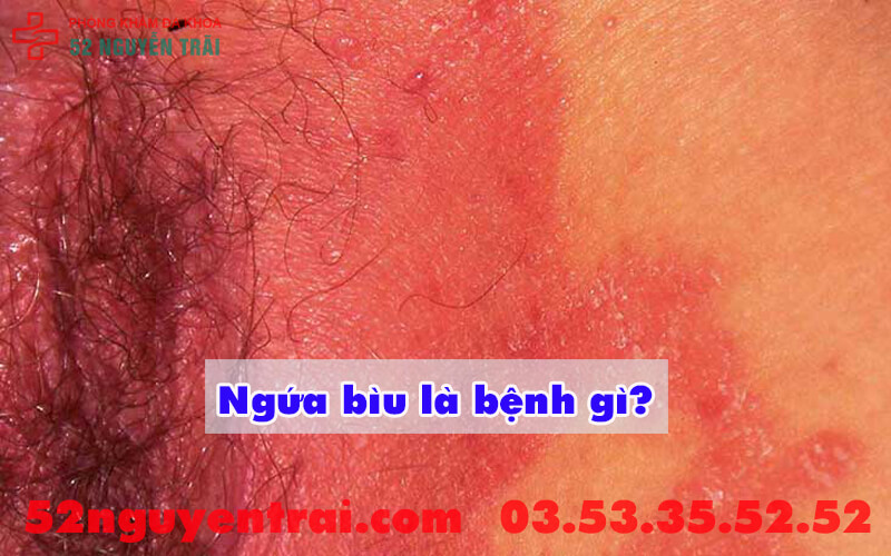 Ngứa bìu là bệnh gì