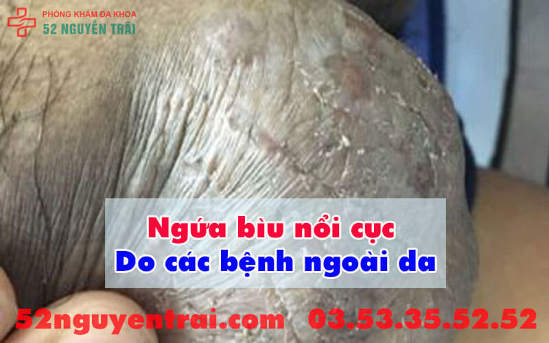 Ngứa bìu nổi cục 1