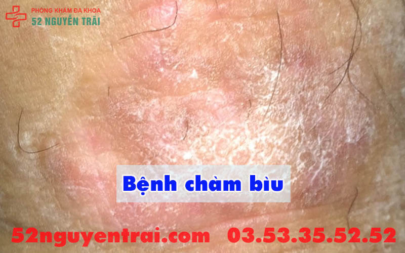 Ngứa bìu ở nam giới 1