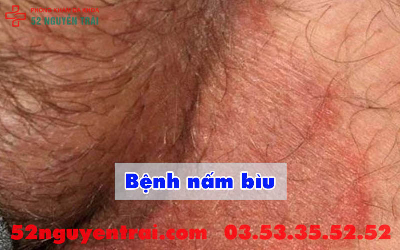 Ngứa bìu ở nam giới 2