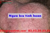 Ngứa bìu tinh hoàn