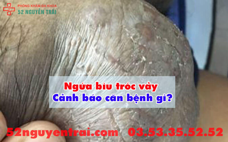 Ngứa bìu tróc vảy 1