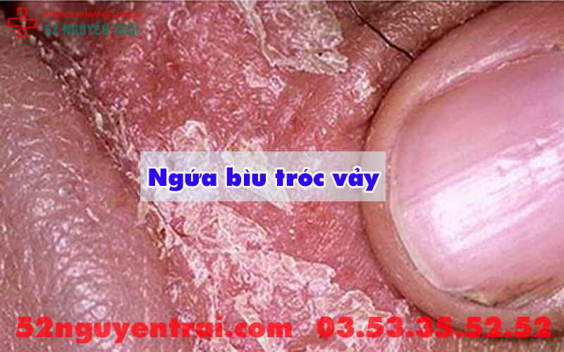 Ngứa bìu tróc vảy