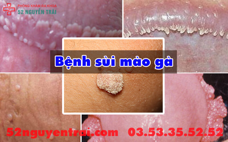 Ngứa bìu và hậu môn 1