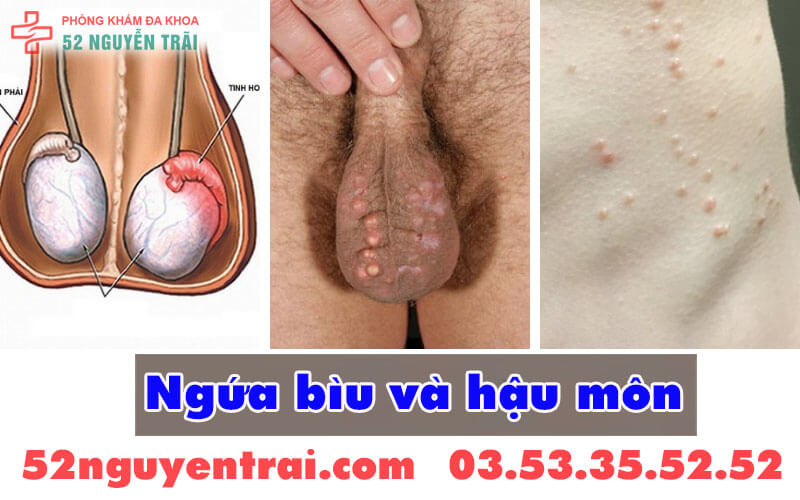 Ngứa bìu và hậu môn