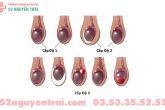 Giãn tĩnh mạch thừng tinh độ 1