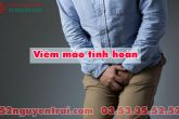 Viêm mào tinh hoàn: Đi tìm triệu chứng và cách điều trị hiệu quả