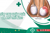 Viêm tinh hoàn phải
